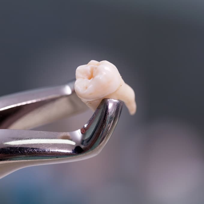 Explaining Wisdom Teeth Removal To Your Patients