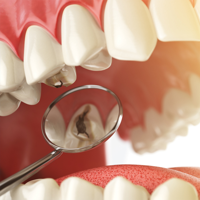 Help Decide between Amalgam and Composite Fillings