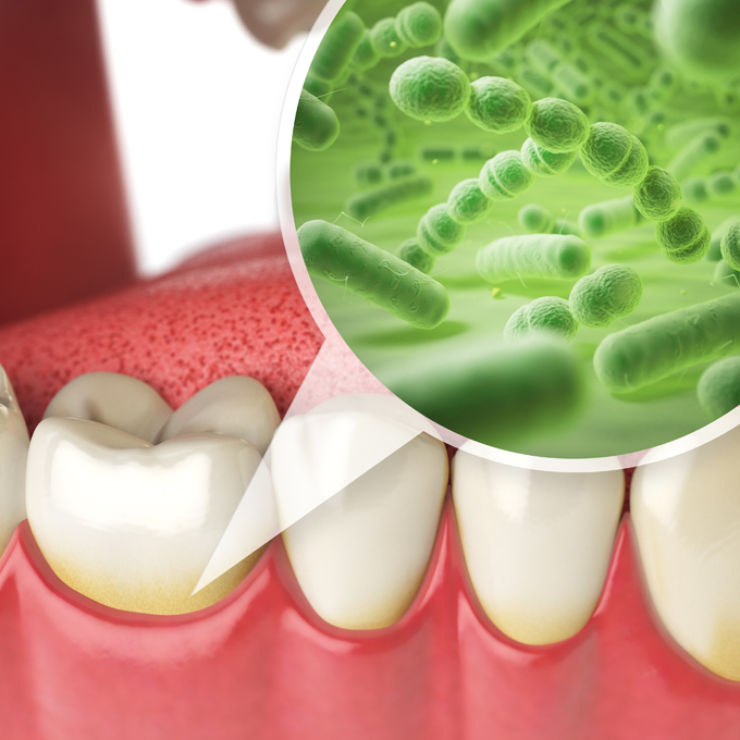 Explaining Periodontal Maintenance to Your Patient