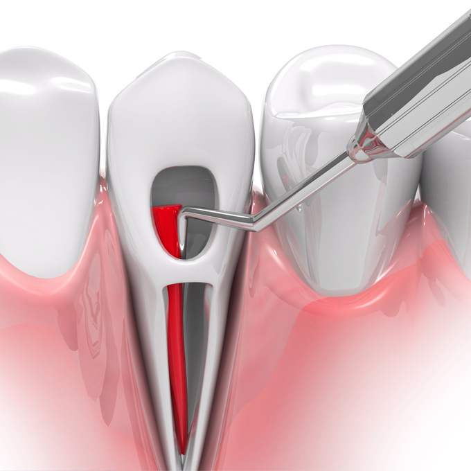 Help Decide Between Extractions and Root Canal/Crowns